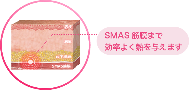 SMAS筋膜まで効率よく熱を与えます